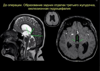 В Таджикистане впервые успешно проведена операция по удалению глубоко расположенной опухоли третьего желудочка мозга