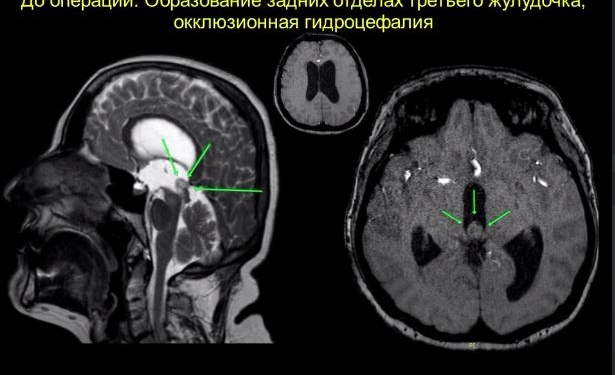 В Таджикистане впервые успешно проведена операция по удалению глубоко расположенной опухоли третьего желудочка мозга